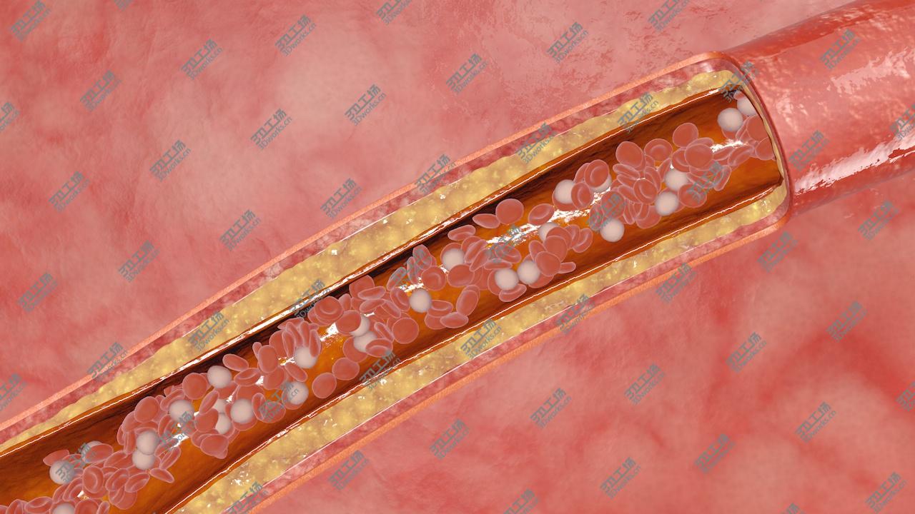 images/goods_img/2021040232/blocked blood vessel animation 3D model/3.jpg